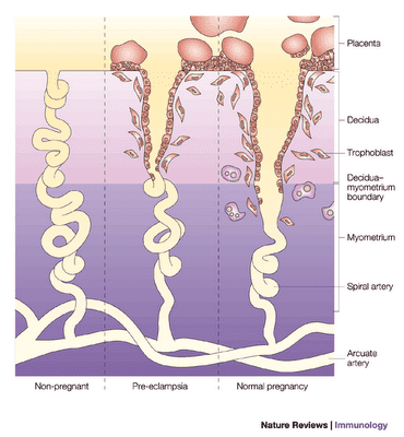 pre-eclampsia